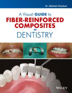 A Visual Guide to Fiber - Reinforced Composites in Dentistry